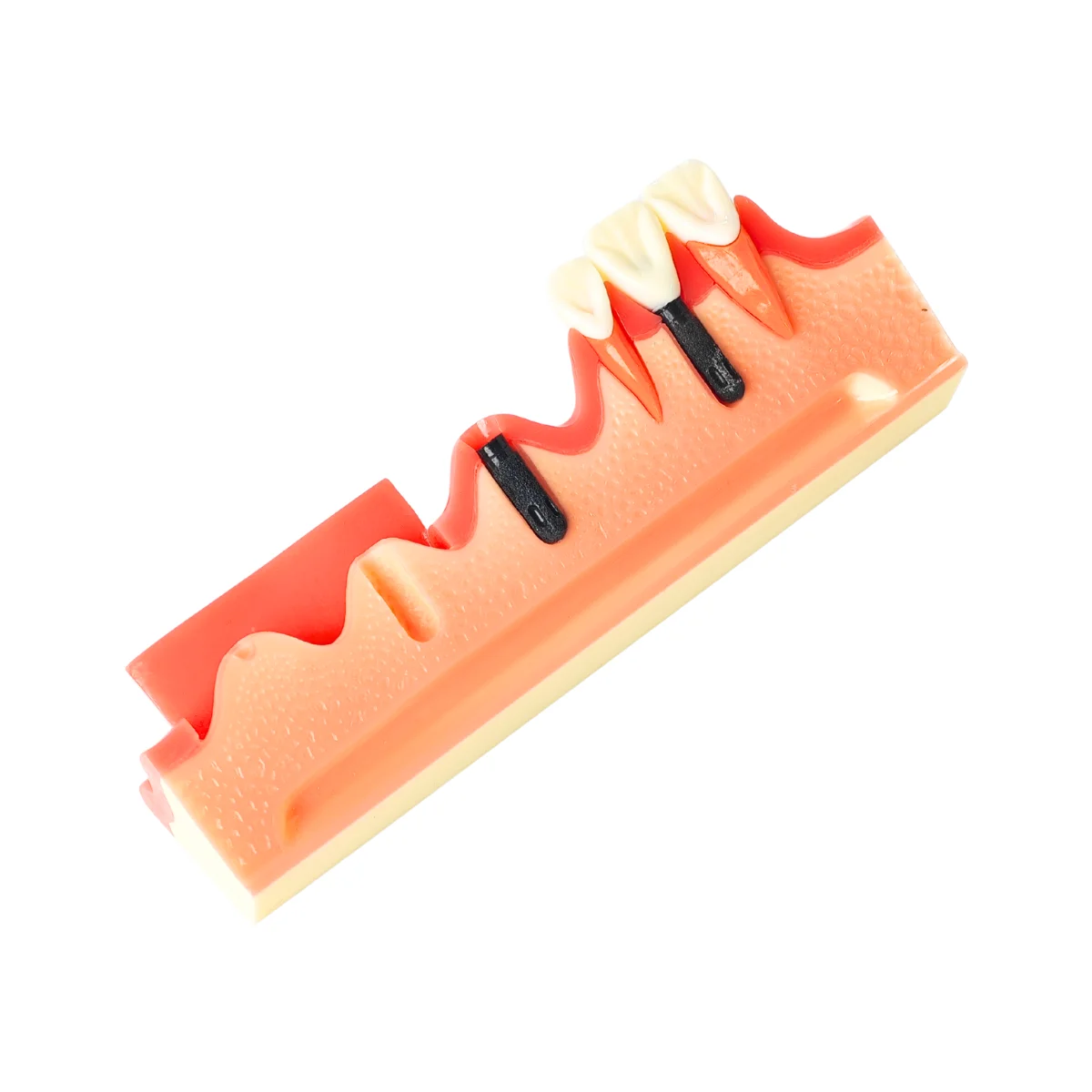 Evodent 4 Step Dental Implant Demonstration Model - Incision, Osteotomy, Implant Placement And Crown Restoration | Buy Now At Evodent Evodent 4 step dental implant demonstration model - incision, osteotomy, implant placement and crown restoration