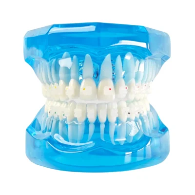 Evodent Orthodontic Model with Ceramic Brackets for Patient Education Model