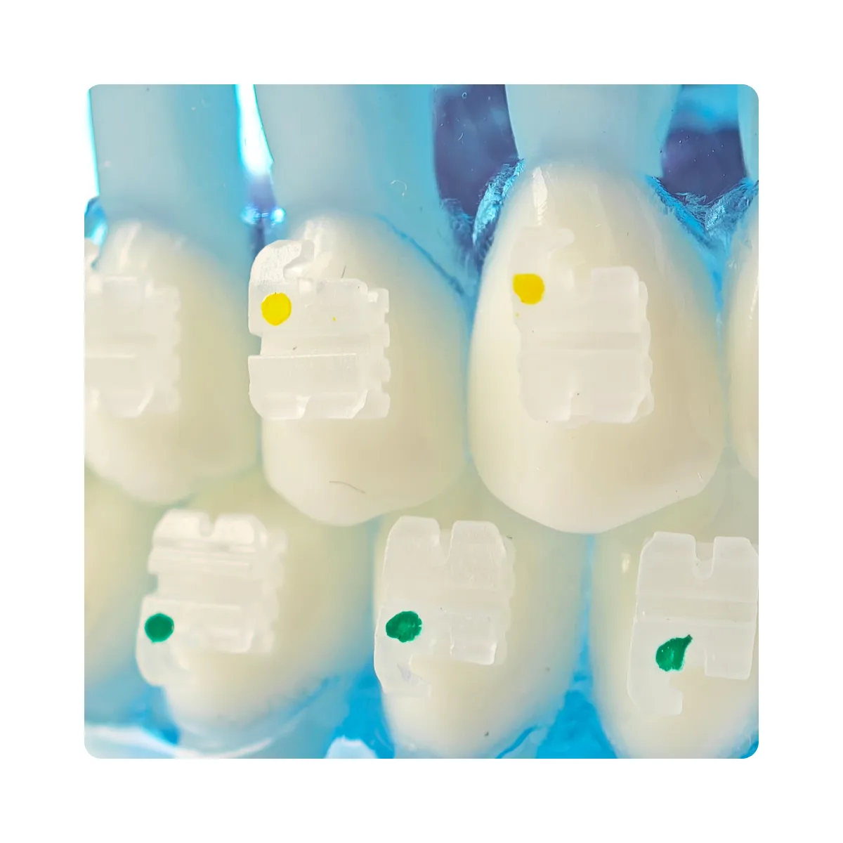 Evodent Orthodontic Model With Ceramic Brackets For Patient Education Model | Buy Now At Evodent Evodent orthodontic model with ceramic brackets for patient education model