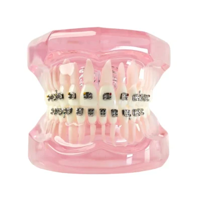 Evodent Orthodontic Patient Education Model with Metal Braces - Pink for Treatment Explanation