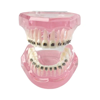 Evodent Orthodontic Patient Education Model with Metal Braces - Pink for Treatment Explanation