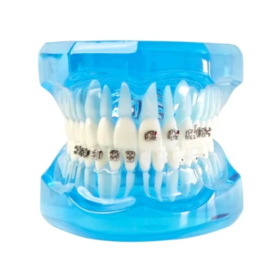 Evodent Orthodontic Model with Self Ligating Bracket