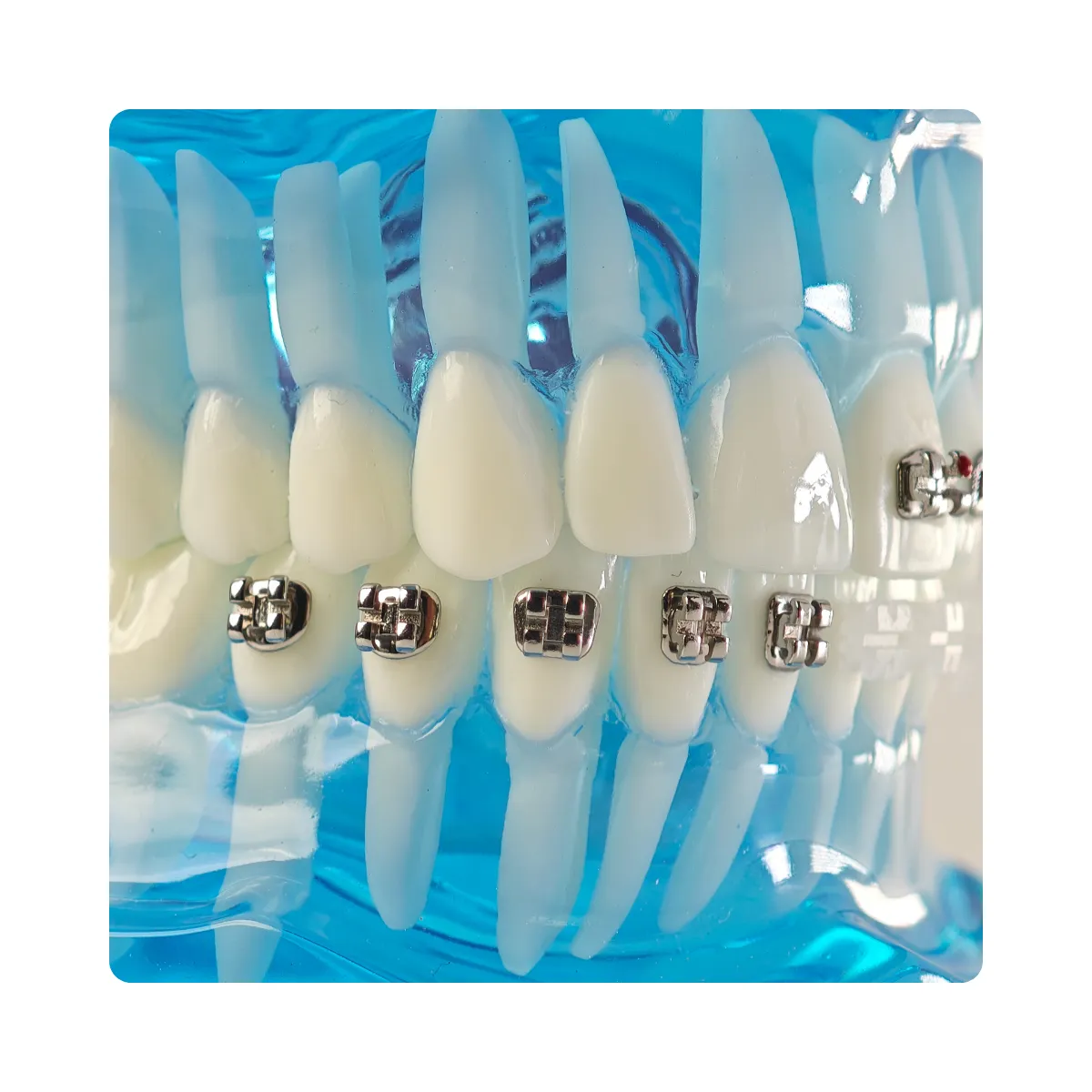 Evodent Three In One Orthodontic Model With Self Ligating Bracket | Buy Now At Evodent Evodent orthodontic model with self ligating bracket