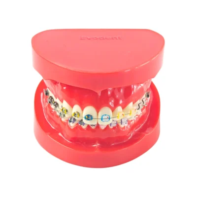 Evodent Metal vs Ceramic Brackets Comparison Model for Patient Education, Orthodontic Model with Half Meta and Half Ceramic Brackets