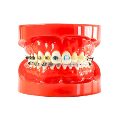 Evodent Metal vs Ceramic Brackets Comparison Model for Patient Education, Orthodontic Model with Half Meta and Half Ceramic Brackets