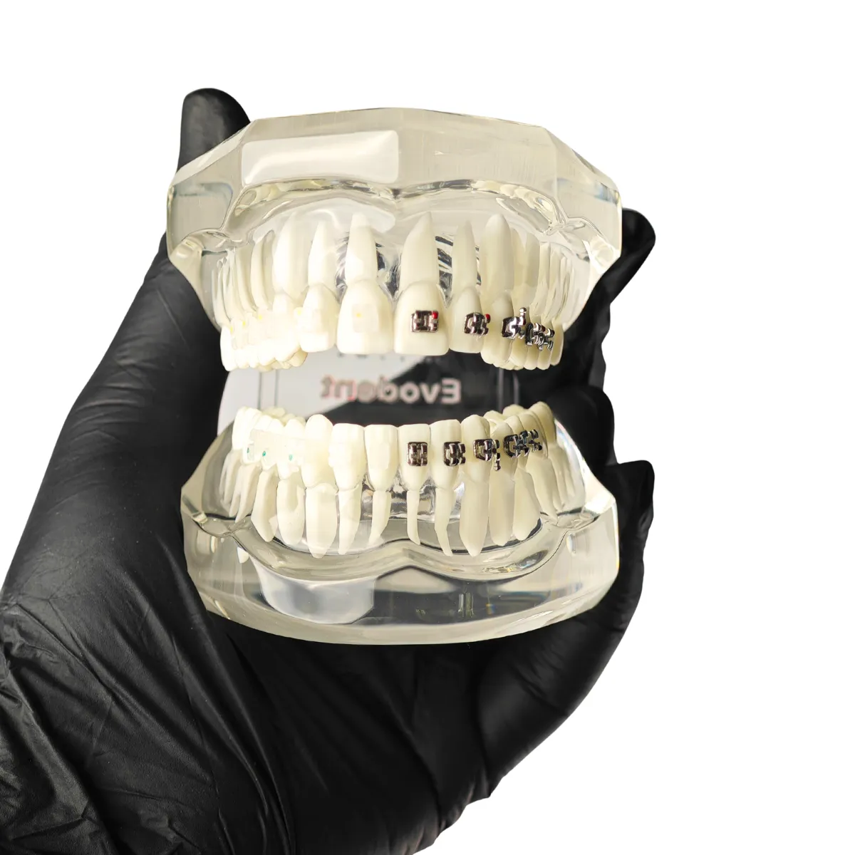 Evodent Orthodontic Model With Metal And Ceramic Brackets For Patient Education, Metal Vs Ceramic Brackets Comparison Model | Buy Now At Evodent Evodent orthodontic model with metal and ceramic brackets for patient education, metal vs ceramic brackets comparison model