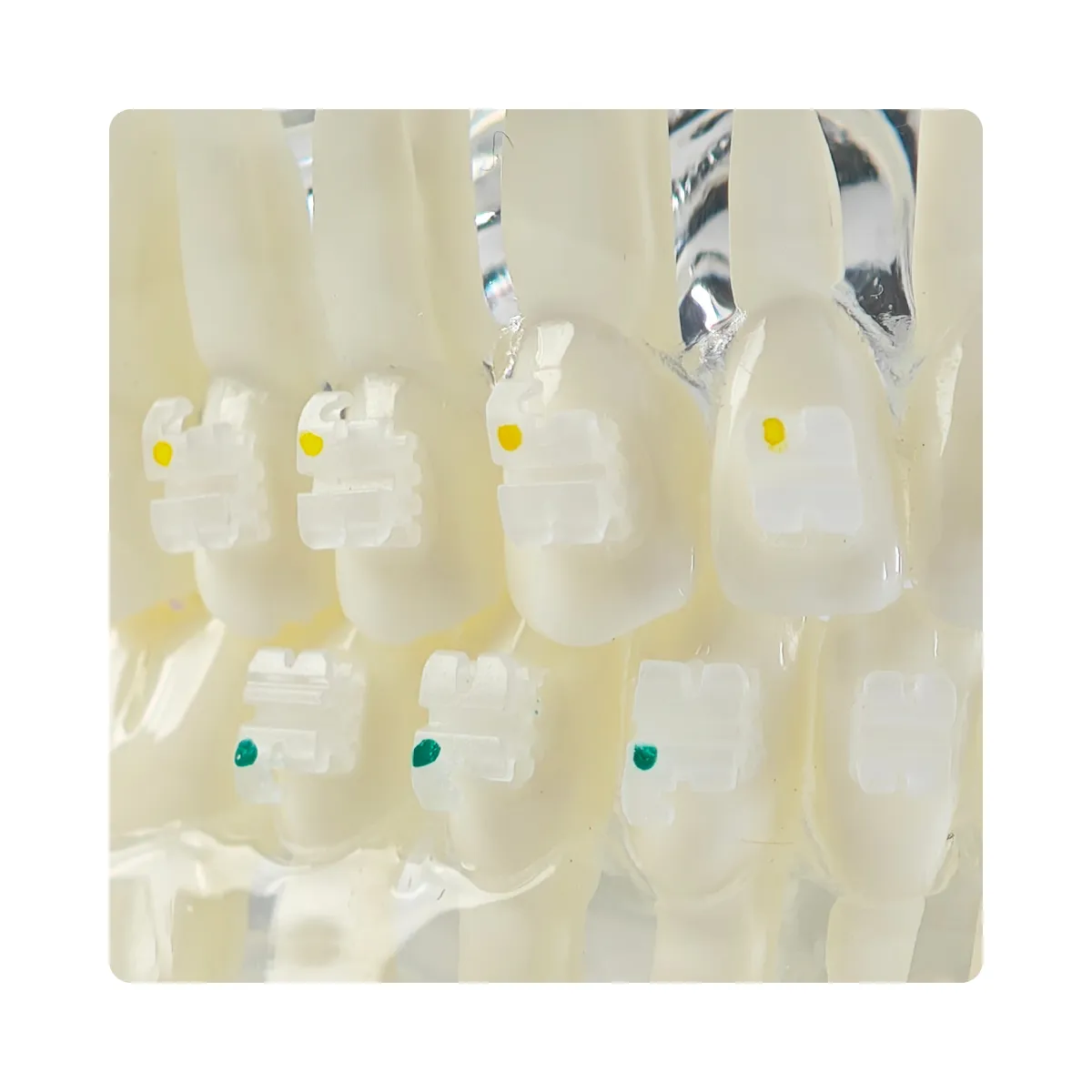 Evodent Orthodontic Model With Metal And Ceramic Brackets For Patient Education, Metal Vs Ceramic Brackets Comparison Model | Buy Now At Evodent Evodent orthodontic model with metal and ceramic brackets for patient education, metal vs ceramic brackets comparison model