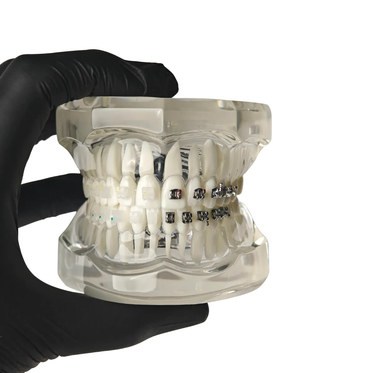 Evodent Orthodontic Model With Metal And Ceramic Brackets For Patient Education, Metal Vs Ceramic Brackets Comparison Model | Buy Now At Evodent Evodent orthodontic model with metal and ceramic brackets for patient education, metal vs ceramic brackets comparison model