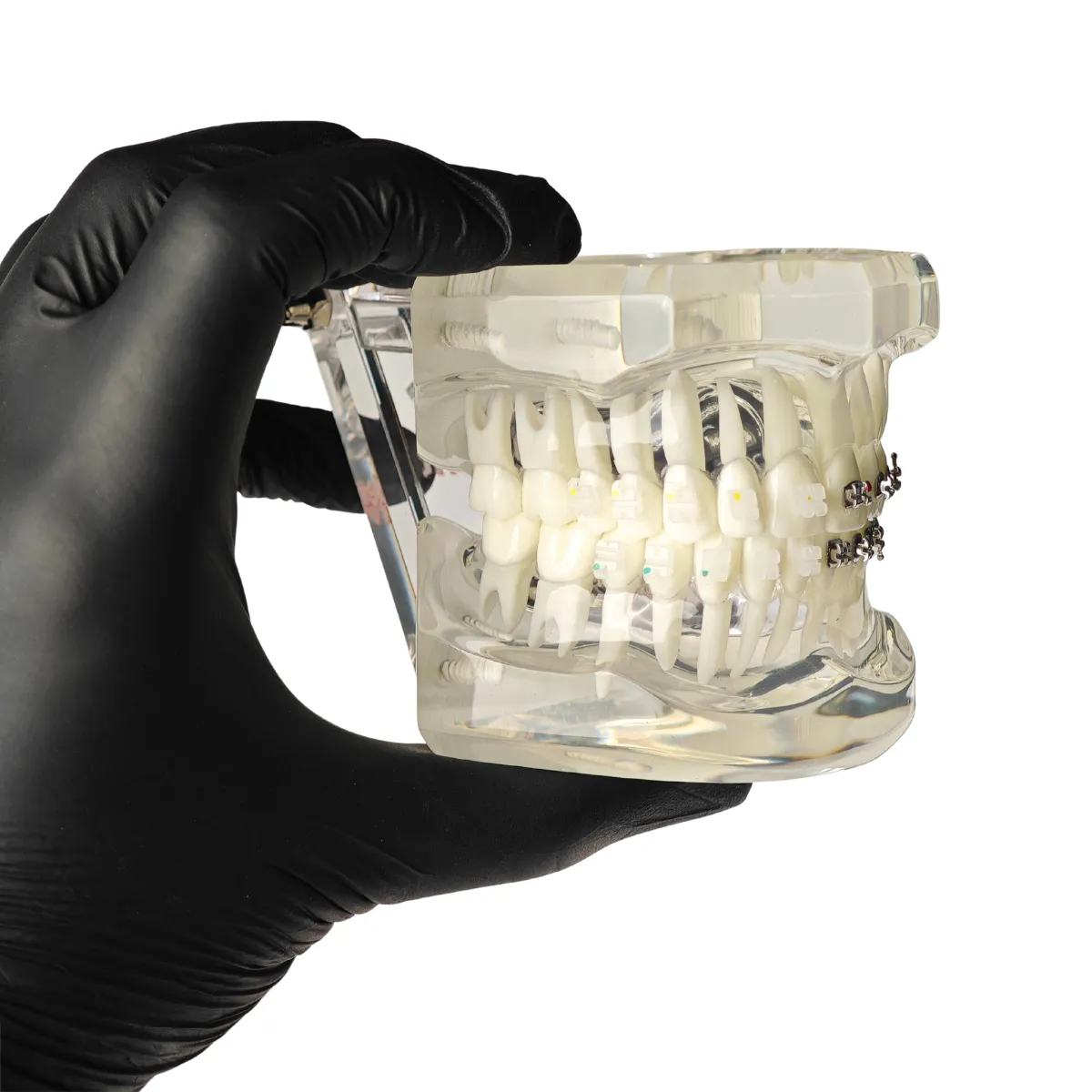 Evodent Orthodontic Model With Metal And Ceramic Brackets For Patient Education, Metal Vs Ceramic Brackets Comparison Model | Buy Now At Evodent Evodent orthodontic model with metal and ceramic brackets for patient education, metal vs ceramic brackets comparison model