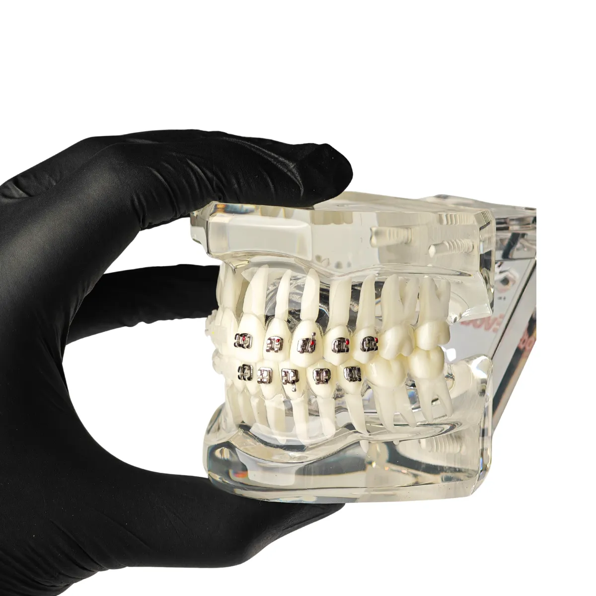 Evodent Orthodontic Model With Metal And Ceramic Brackets For Patient Education, Metal Vs Ceramic Brackets Comparison Model | Buy Now At Evodent Evodent orthodontic model with metal and ceramic brackets for patient education, metal vs ceramic brackets comparison model