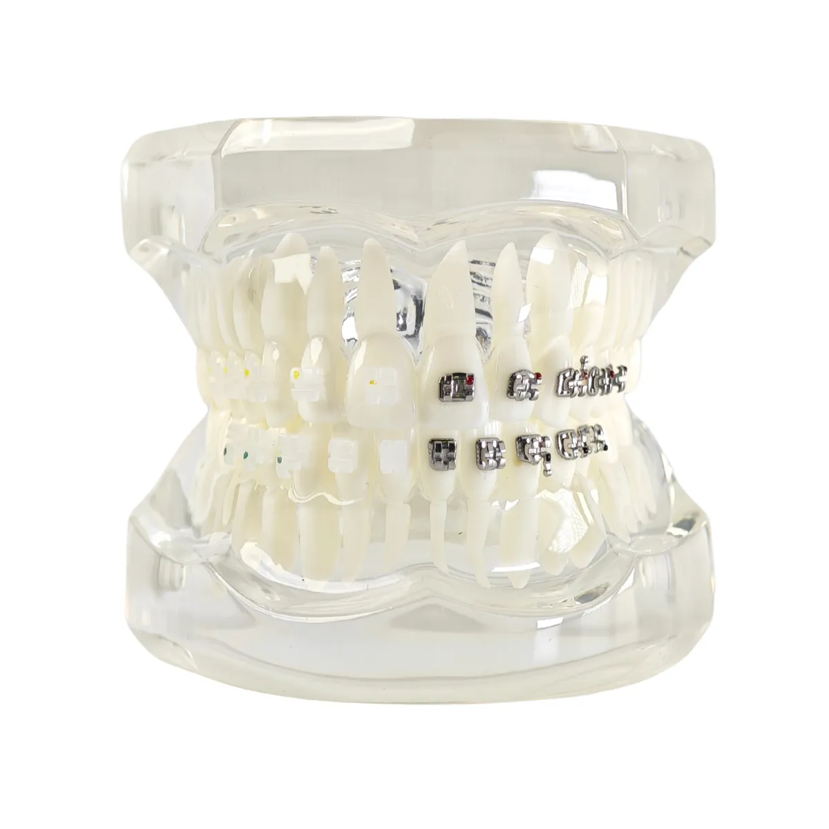 Evodent Orthodontic Model With Metal And Ceramic Brackets For Patient Education, Metal Vs Ceramic Brackets Comparison Model | Buy Now At Evodent Evodent orthodontic model with metal and ceramic brackets for patient education, metal vs ceramic brackets comparison model