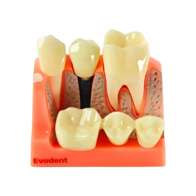 Home | Buy Now At Evodent Evodent dental implant demonstration model for patient education