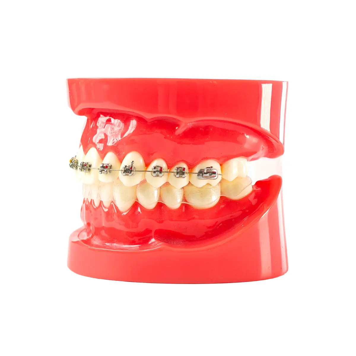 Evodent Orthodontic Braces Vs Aligners Comparison Model For Patient Education (Fixed Appliances Vs Clear Aligners) | Buy Now At Evodent Evodent orthodontic braces vs aligners comparison model for patient education (fixed appliances vs clear aligners)