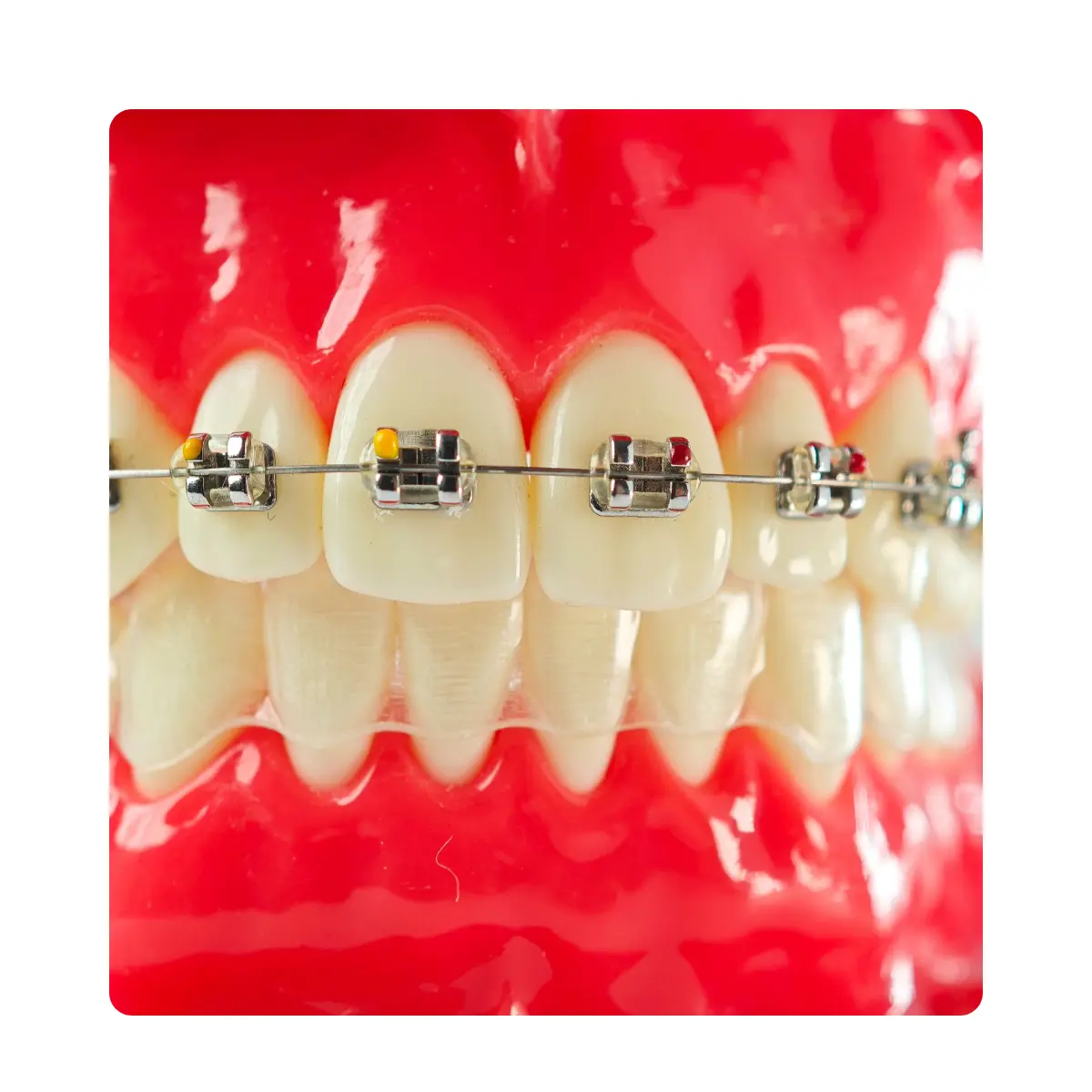 Evodent Orthodontic Braces Vs Aligners Comparison Model For Patient Education (Fixed Appliances Vs Clear Aligners) | Buy Now At Evodent Evodent orthodontic braces vs aligners comparison model for patient education (fixed appliances vs clear aligners)