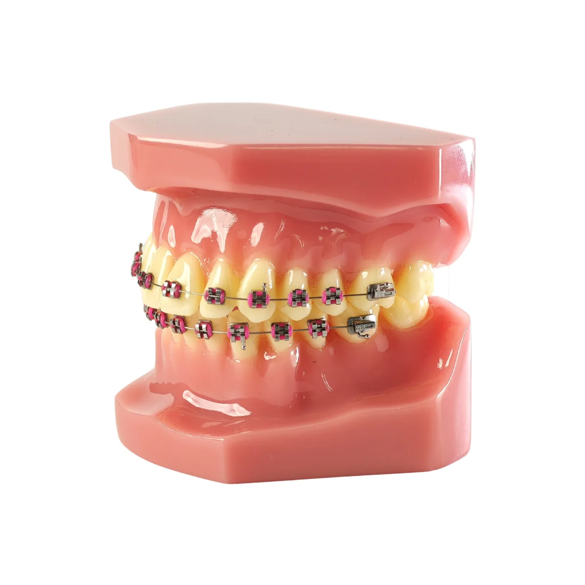 Evodent Orthodontic Model With Metal Braces And Pink Ligatures - Dental Braces Patient Education Model | Buy Now At Evodent Evodent orthodontic model with metal braces and pink ligatures - dental braces patient education model