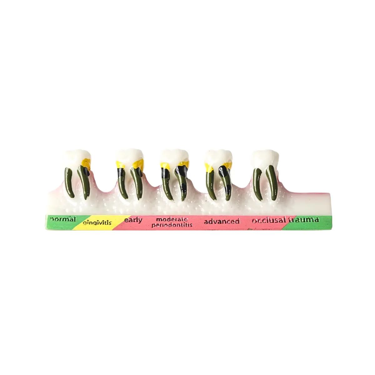 Evodent Periodontal Disease Progression Model – Gingivitis, Periodontitis &Amp; Occlusal Trauma | Buy Now At Evodent Evodent periodontal disease progression model, patient education