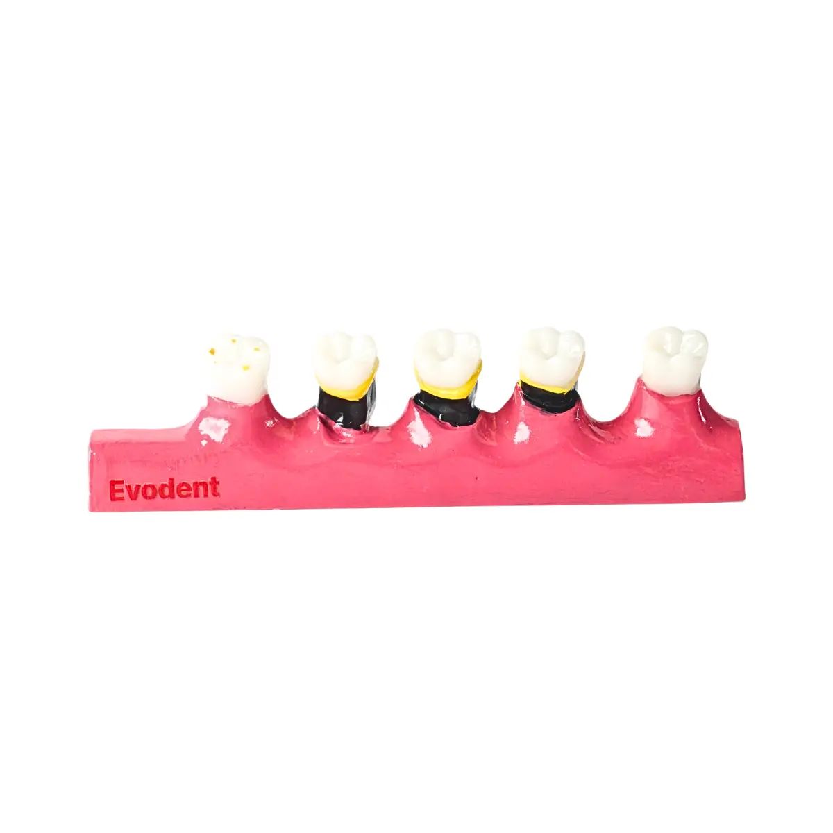 Evodent Periodontal Disease Progression Model – Gingivitis, Periodontitis &Amp; Occlusal Trauma | Buy Now At Evodent Evodent periodontal disease progression model, patient education