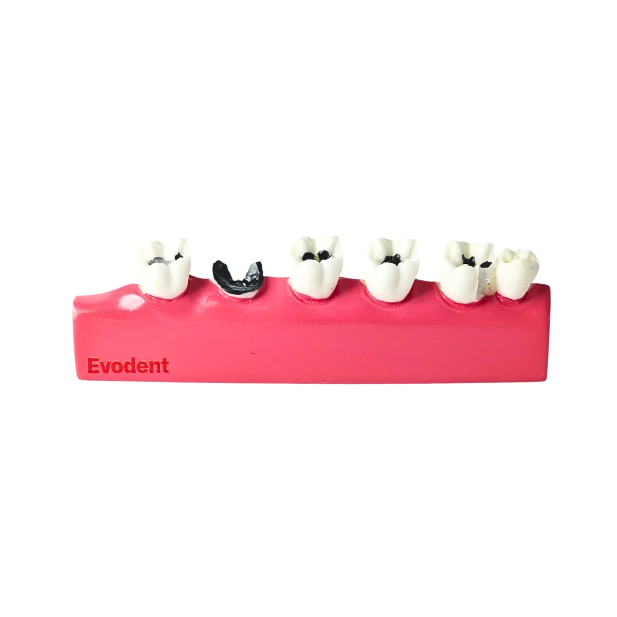 Evodent Dental Caries Progression Model – Tooth Decay &Amp; Patient Education Model | Buy Now At Evodent Evodent tooth decay & caries progression model