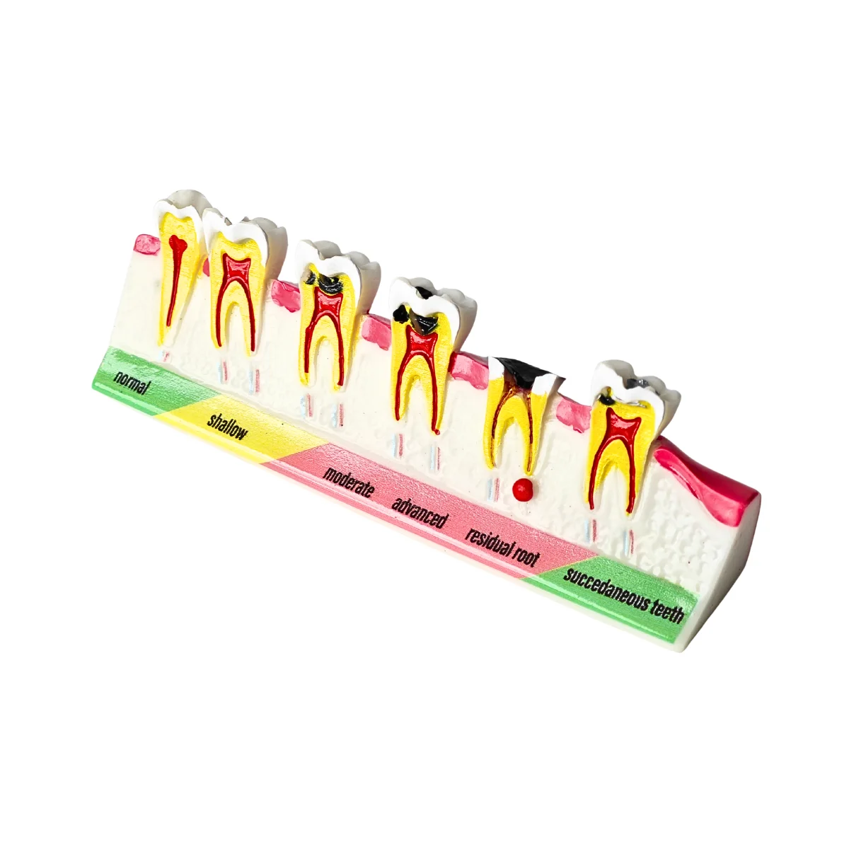 Evodent Dental Caries Progression Model – Tooth Decay &Amp; Patient Education Model | Buy Now At Evodent Evodent tooth decay & caries progression model
