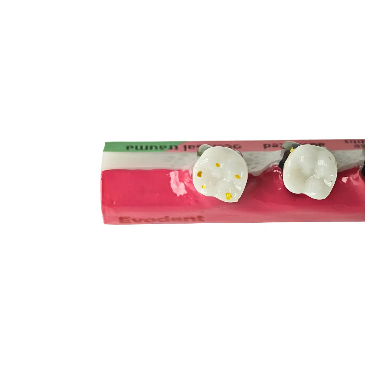 Evodent Periodontal Disease Progression Model – Gingivitis, Periodontitis &Amp; Occlusal Trauma | Buy Now At Evodent Evodent periodontal disease progression model, patient education