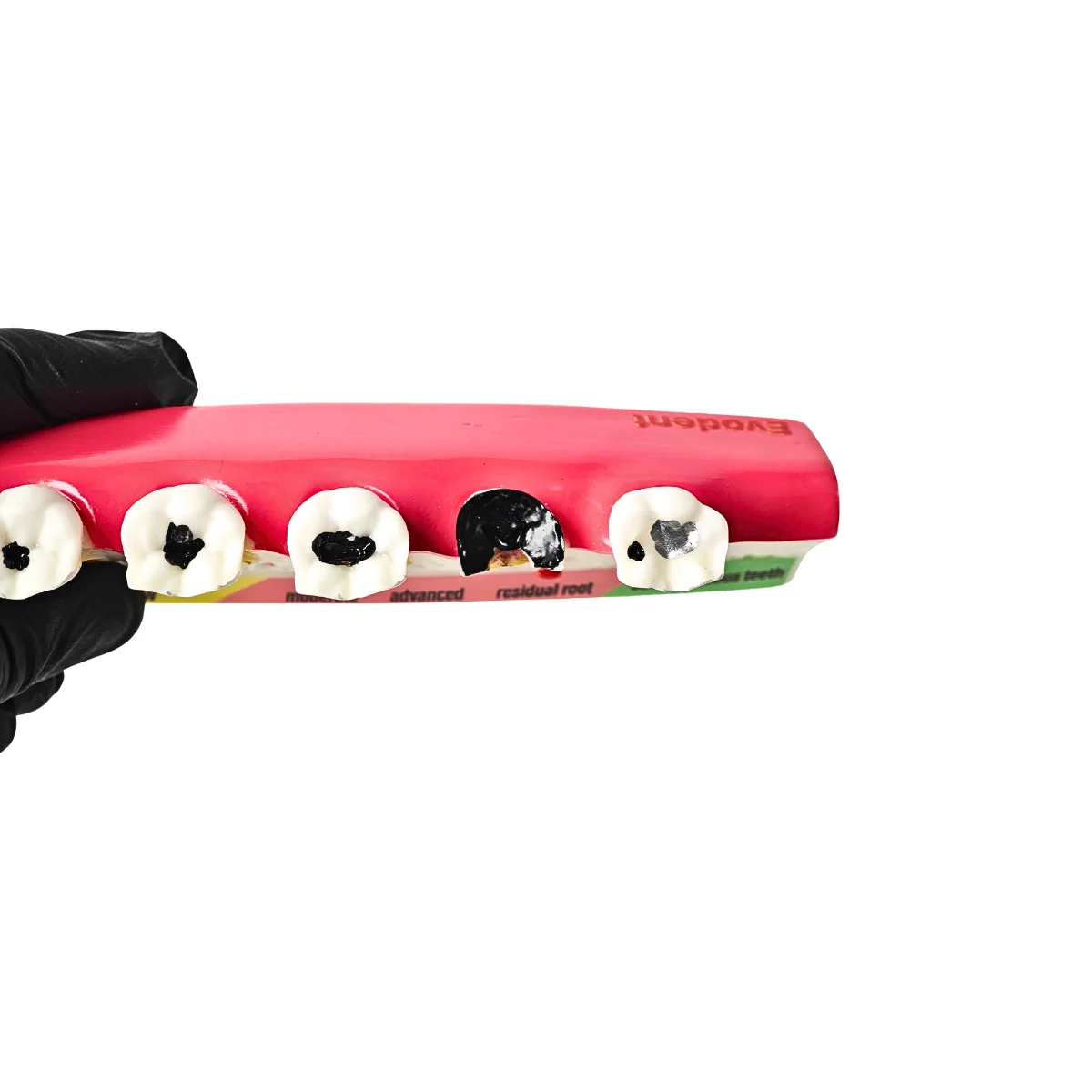 Evodent Dental Caries Progression Model – Tooth Decay &Amp; Patient Education Model | Buy Now At Evodent Evodent tooth decay & caries progression model