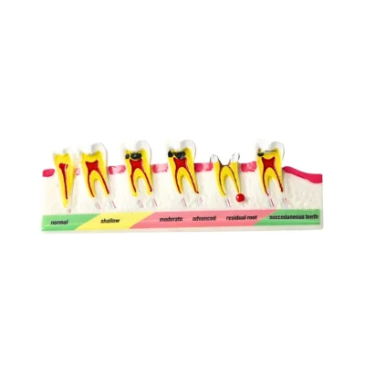 Evodent Tooth Decay & Caries Progression Model