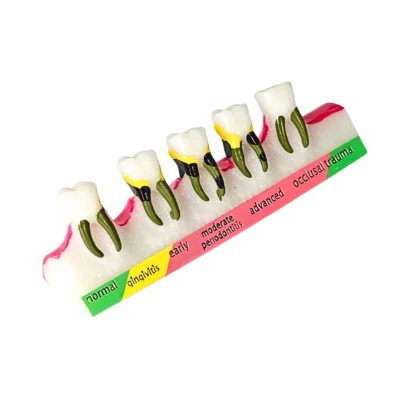 Evodent Periodontal Disease Progression Model, Patient Education