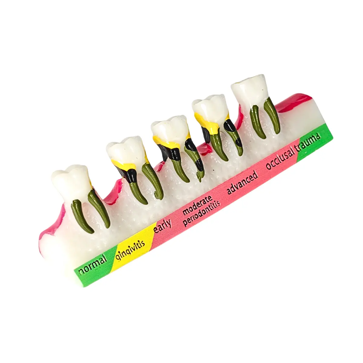 Evodent Periodontal Disease Progression Model – Gingivitis, Periodontitis &Amp; Occlusal Trauma | Buy Now At Evodent Evodent periodontal disease progression model, patient education