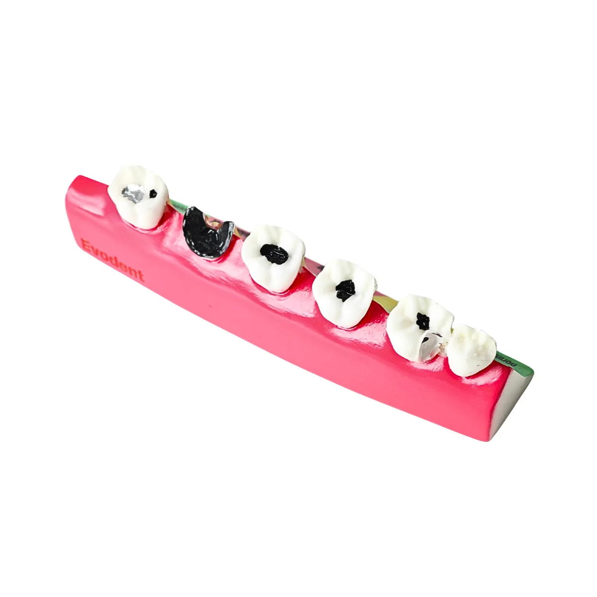 Evodent Dental Caries Progression Model – Tooth Decay &Amp; Patient Education Model | Buy Now At Evodent Evodent tooth decay & caries progression model