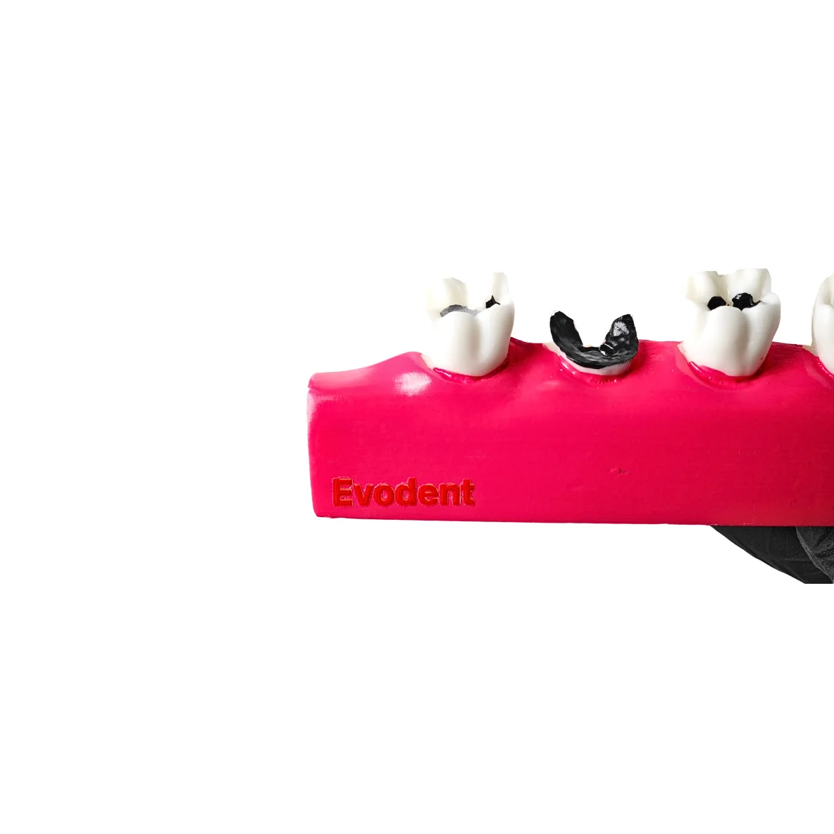 Evodent Dental Caries Progression Model – Tooth Decay &Amp; Patient Education Model | Buy Now At Evodent Evodent tooth decay & caries progression model